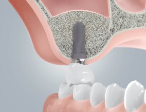 Knochenaufbau Implantat